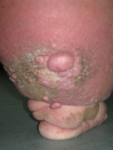 obrzęk limfatyczny ze znacznym zaburzeniem trofiki skóry